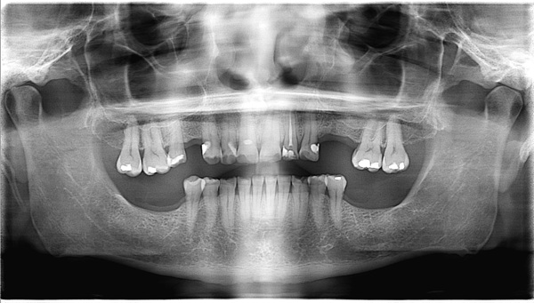 Dental-Implant