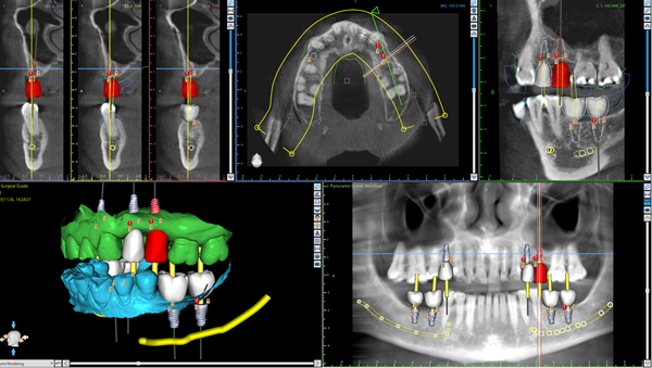 Dental-Implant
