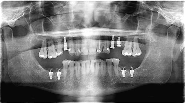 Dental-Implant