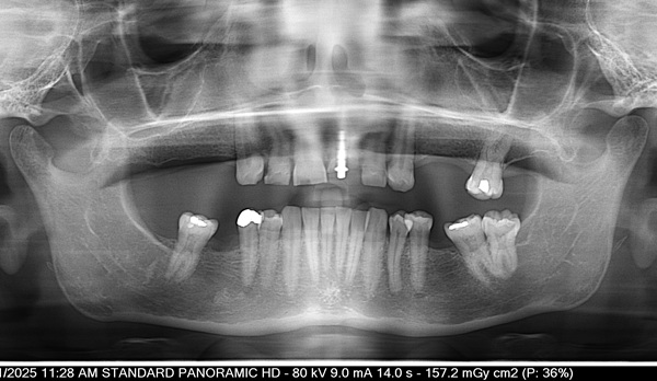 Dental-Implant
