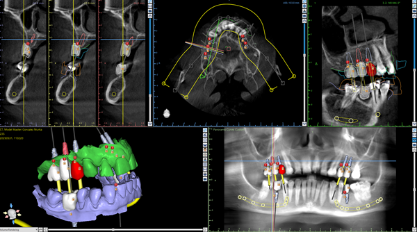 Dental-Implant