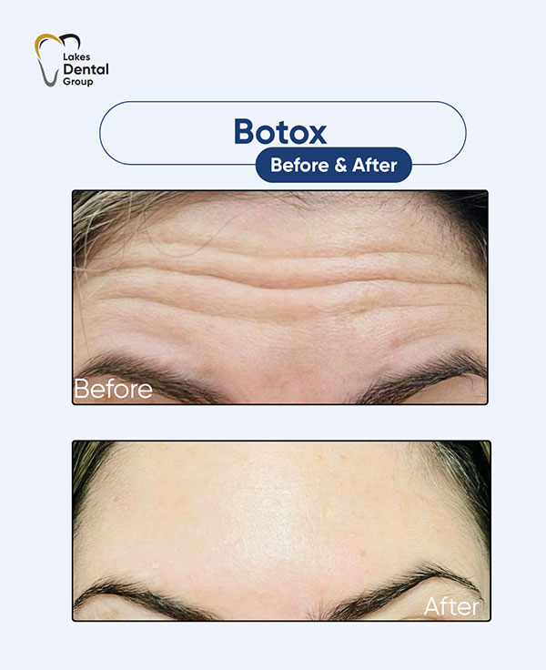 botox before and after