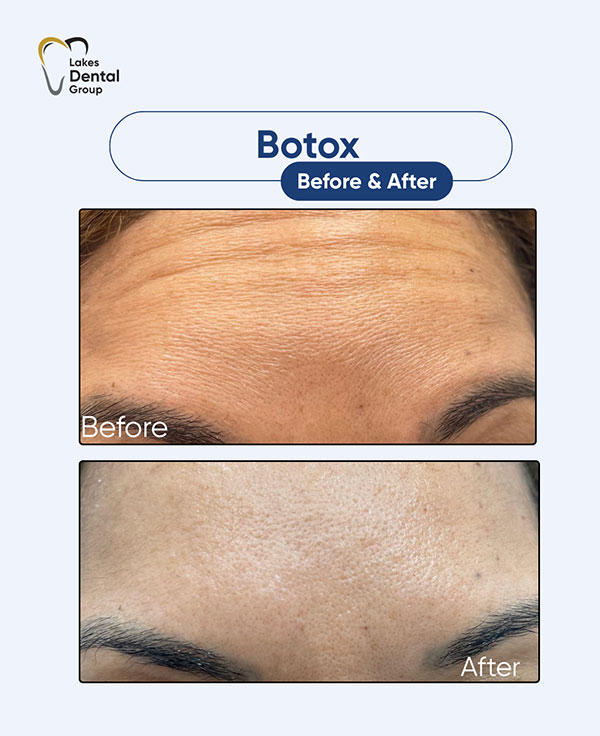botox before and after