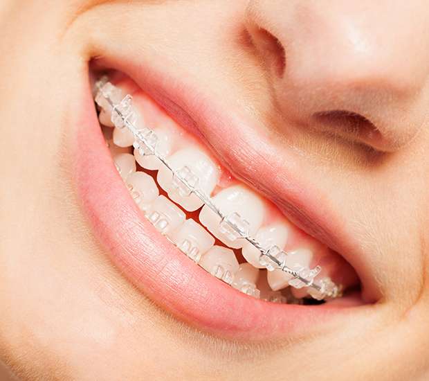 Miami Lakes Clear Braces