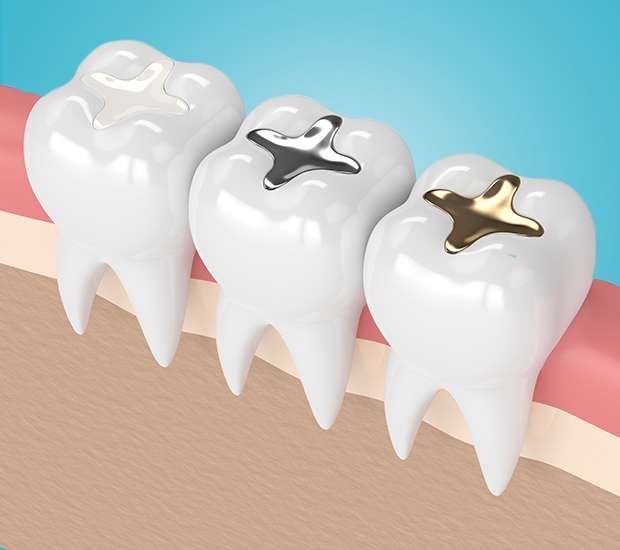 Miami Lakes Composite Fillings