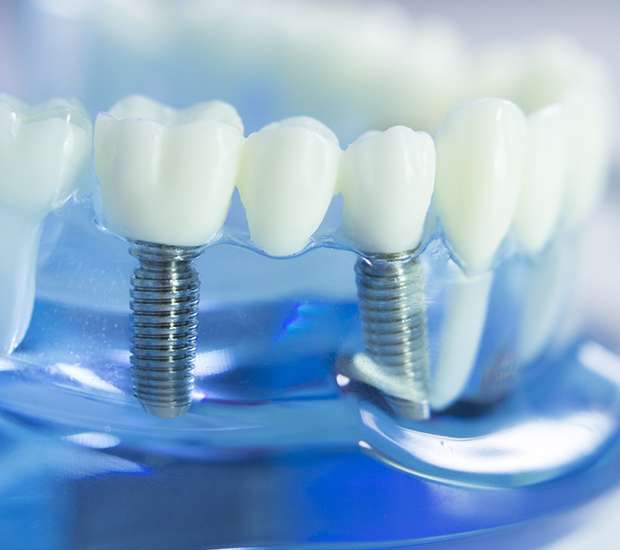 Miami Lakes Dental Implants
