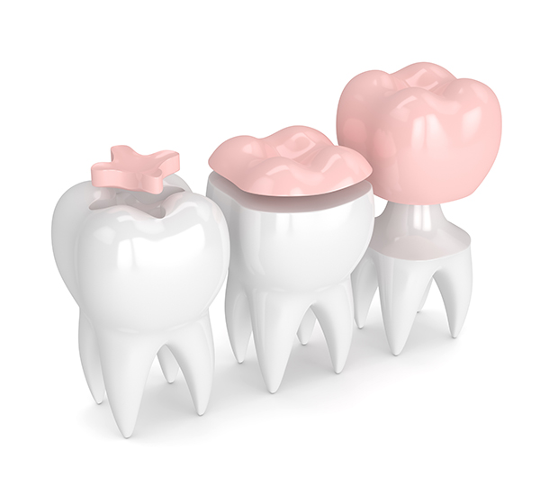 Miami Lakes Dental Inlays and Onlays