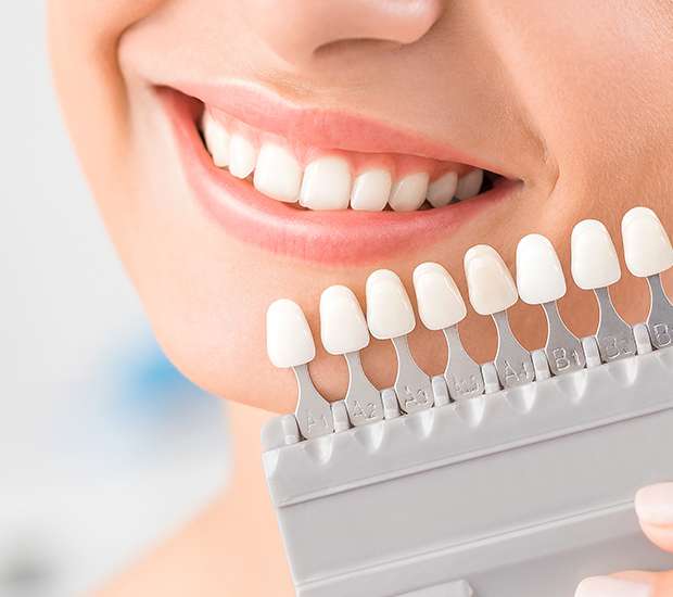 Miami Lakes Dental Veneers and Dental Laminates